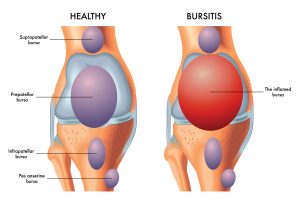 A medical illustration of a knee with an inflamed prepatellar bursa